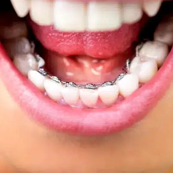 Bonded Orthodontic Retainers Near Chicago | Hurley & Volk Orthodontics