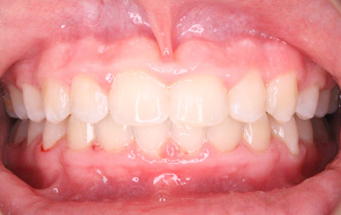 Teeth After Braces - Andrew B. | Hurley & Volk