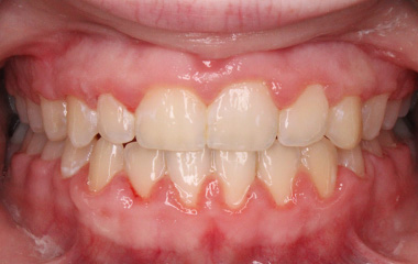 Teeth After Braces - Gianna B. | Hurley & Volk