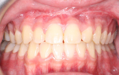 Teeth After Braces - Ian | Hurley & Volk