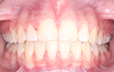 Teeth After Braces - Isabella B. | Hurley & Volk