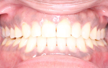 Teeth After Invisalign - Jobin | Hurley & Volk
