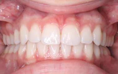 Teeth After Invisalign - Montana B. | Hurley & Volk