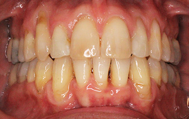 Teeth After Invisalign - Piercarlo B. | Hurley & Volk