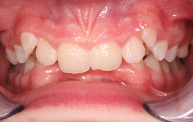 Teeth Before Braces - Andrew B. | Hurley & Volk