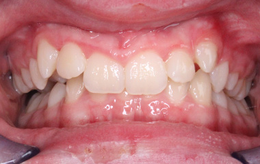Teeth Before Invisalign - Evan B. | Hurley & Volk