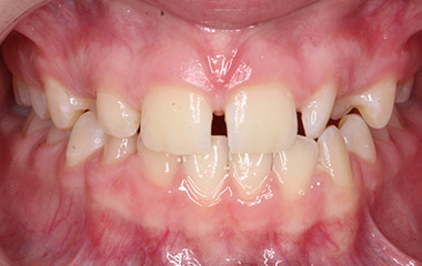 Teeth Before Braces - Gianna B. | Hurley & Volk