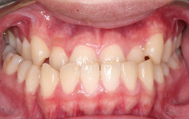 Teeth Before Braces - Ian B. | Hurley & Volk