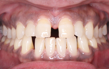 Teeth Before Invisalign - Jobin B. | Hurley & Volk