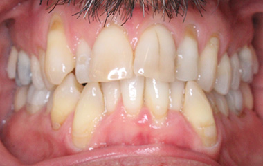 Teeth Before Invisalign - Piercario | Hurley & Volk